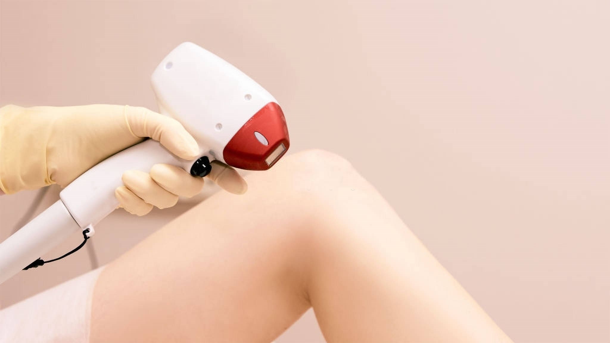 Depilação a laser e pelos brancos