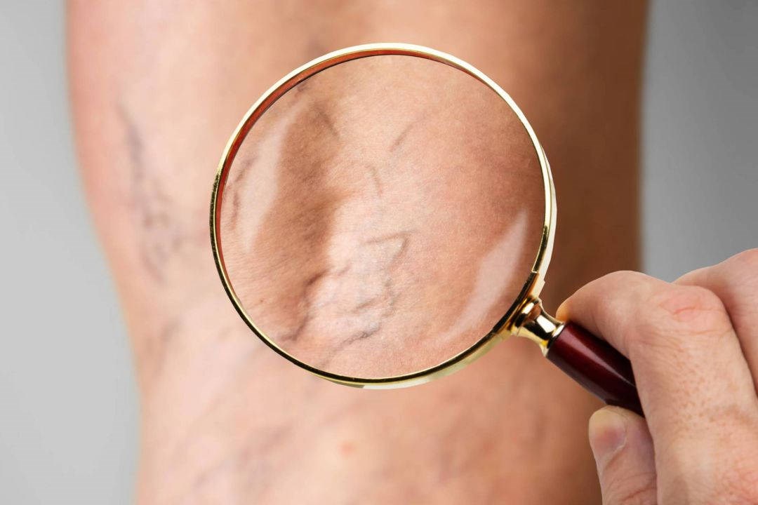 Tratamento de Microvasos (PEIM) em Uberlândia